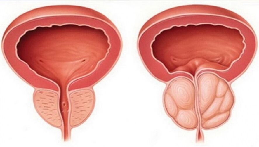 prostate healthy and inflamed with prostatitis