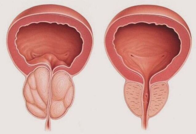 prostate healthy and inflamed with prostatitis