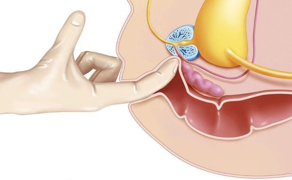 Prostate massage to treat prostatitis