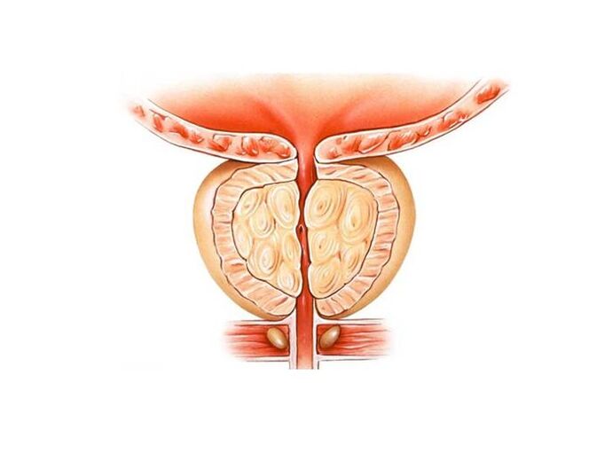 prostatitis